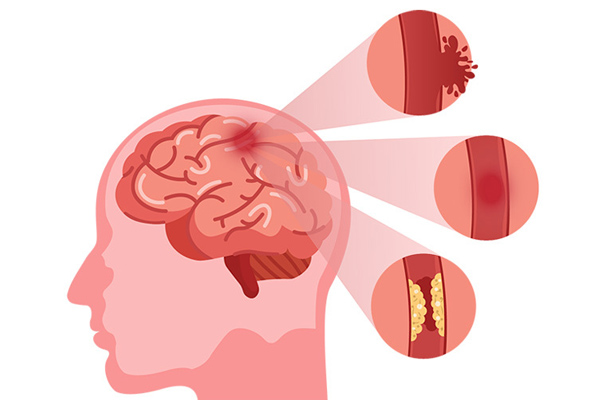 Neurology